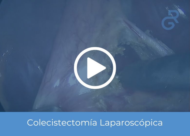 Colecistectomía Robótica