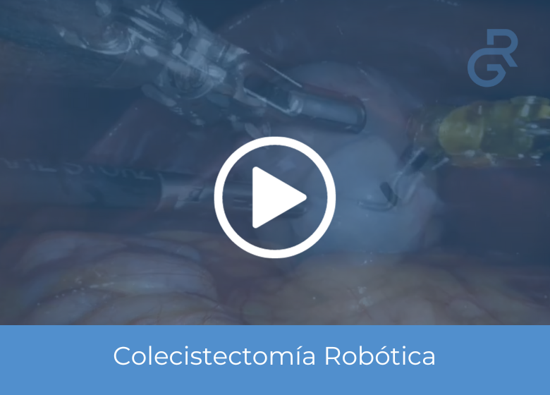 Colecistectomía Robótica