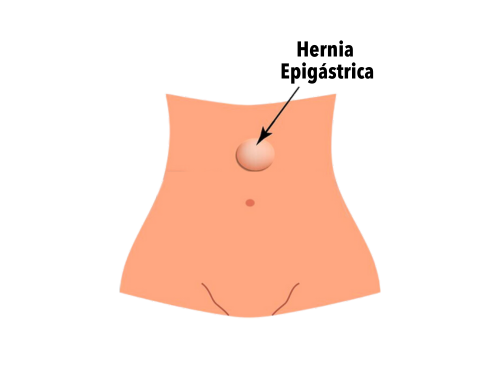 hernia-epigastrica-2