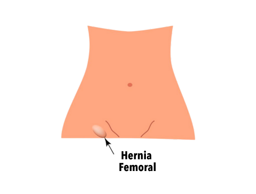 hernia-femoral-2
