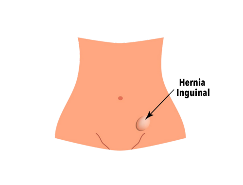 hernia-inguinal-2