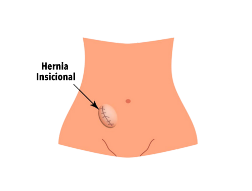 hernia-insicional-2