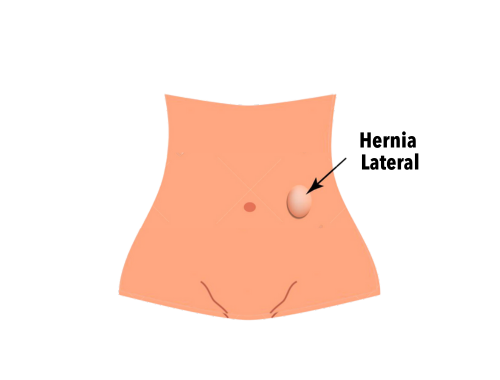 hernia-lateral-2