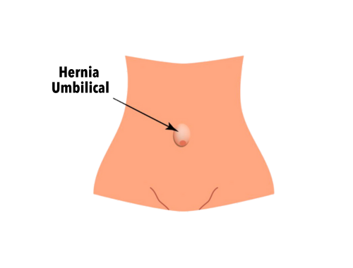 hernia-umbilical-2